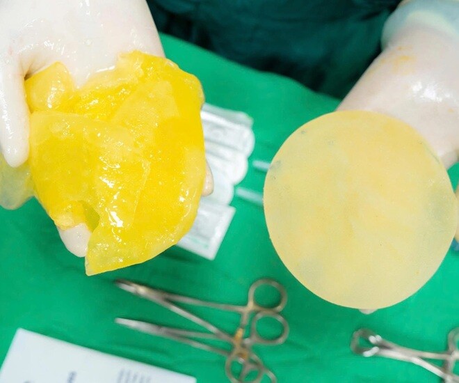 Hình ảnh túi ngực của cô gái bị vỡ lan truyền trên mạng xã hội. Ảnh: MXH. 