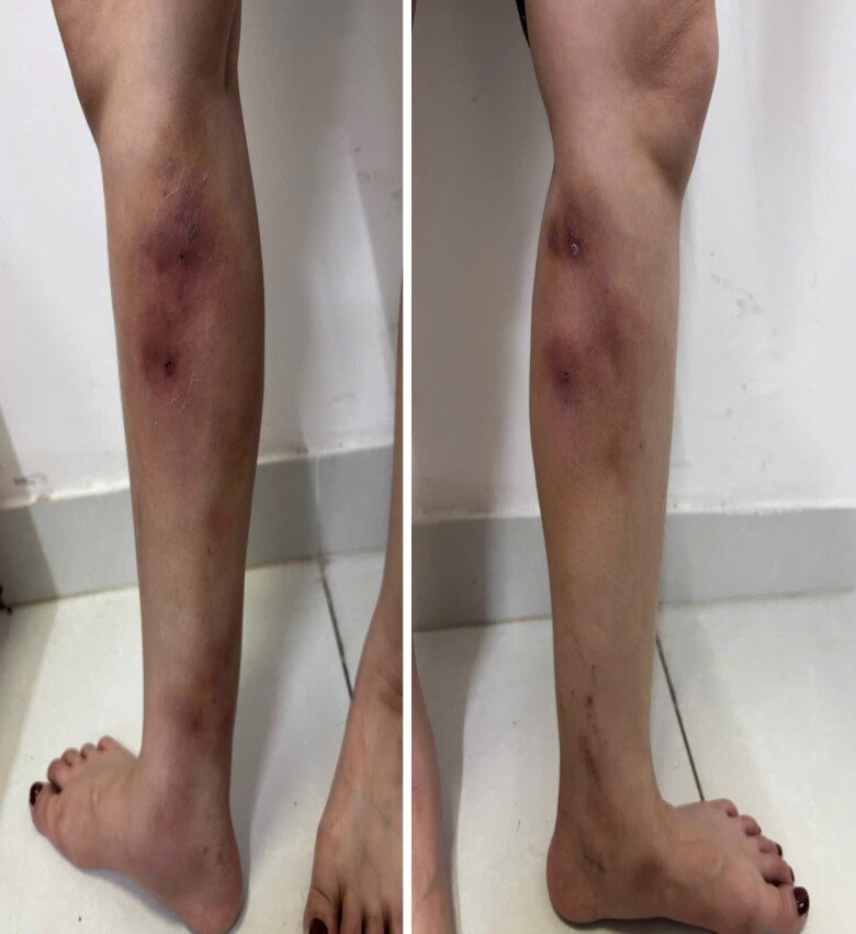 Hình ảnh hai cẳng chân bị biến dạng sau khi tiêm làm thẳng chân. Ảnh: BSCC. 