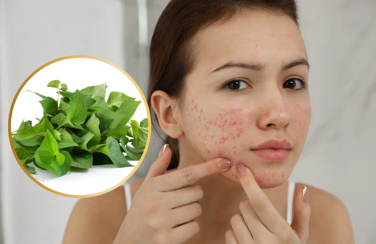 Do có tính kháng khuẩn, rau diếp cá giúp hỗ trợ điều trị bệnh về da rất tốt.