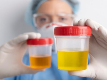 Sức khỏe - Ngoài bệnh phụ khoa, màu nước tiểu còn cảnh báo nguy cơ mắc căn bệnh nguy hiểm nào ở chị em phụ nữ?