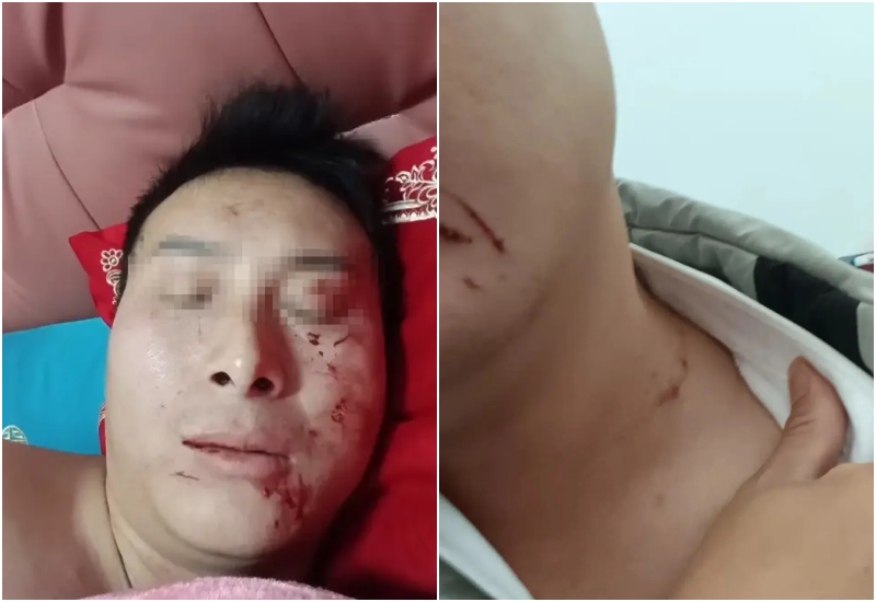 Chị Lý Xảo đã cào anh Lữ chảy máu.