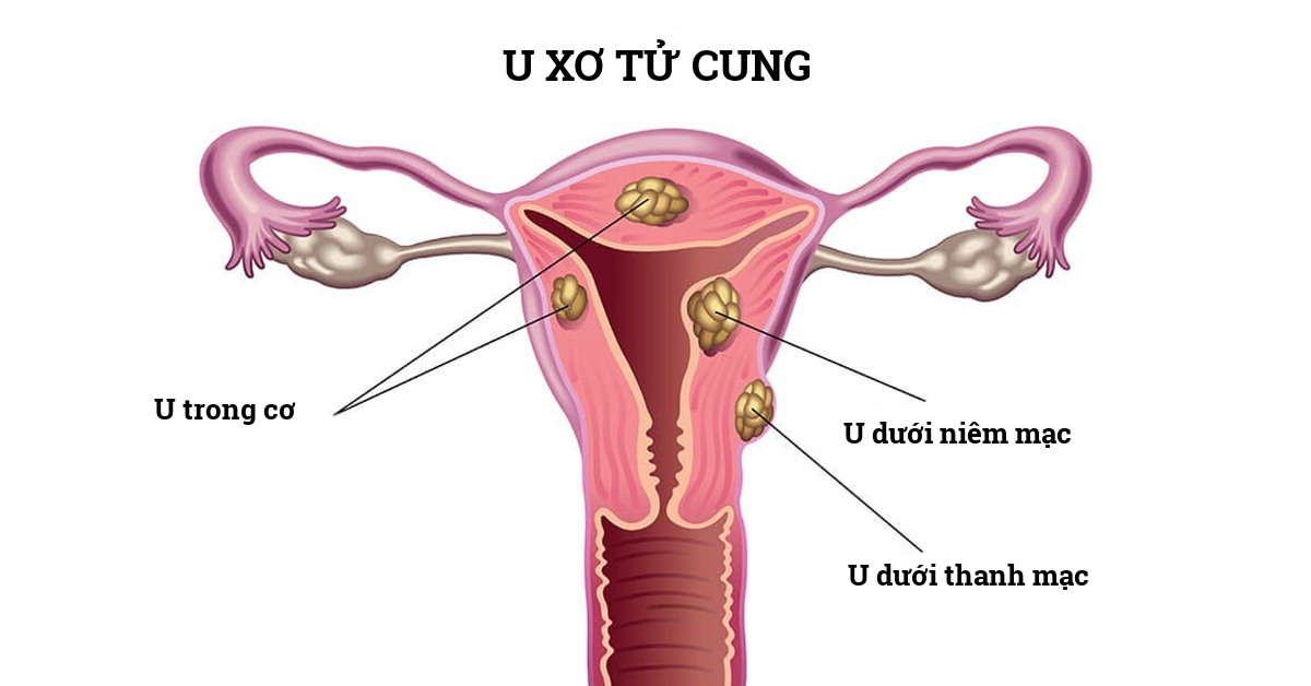 U xơ tử cung có thể nằm ở các vị trí phổ biến: niêm mạc, cơ, thanh mạc gây ảnh hưởng đến sức khỏe và sinh hoạt của người bệnh