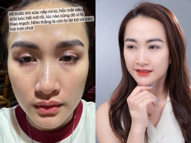 Vào năm 2024, bà xã Hà Việt Dũng công khai can thiệp thẩm mỹ, cắt mí ghép mỡ để gương mặt trở nên hoàn hảo hơn.