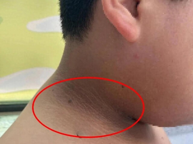 Mẹ phát hiện trên cổ, nách và đùi con trai dậy thì có những vạch màu đen kỳ lạ, bác sĩ cảnh báo nguy hiểm