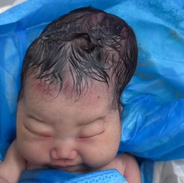 Bé gái sơ sinh chào đời với cái đầu nhọn, bố sợ hãi không nhận con, bác sĩ báo tin vui - 2