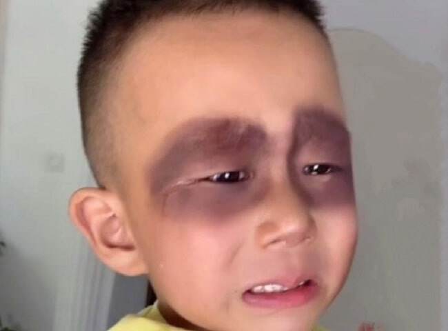 Bé trai 5 tuổi ngủ dậy khóc thét vì mặt bỗng bầm tím, nguyên nhân từ thói quen tai hại mỗi ngày - 2