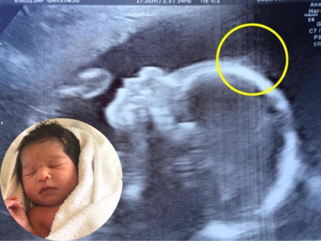 Bà bầu - Đến viện siêu âm, mẹ bầu giật mình thấy điểm lạ trên đầu con, cái kết bé gái sinh ra đã nổi tiếng vì quá xinh