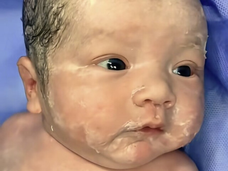 Con sơ sinh chào đời với nhiều lớp vảy trên cơ thể, bố sợ không dám bế liền bị bác sĩ mắng thiếu hiểu biết