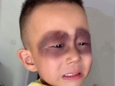 Bé trai 5 tuổi ngủ dậy khóc thét vì mặt bỗng bầm tím, nguyên nhân từ thói quen tai hại mỗi ngày