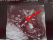 Bà bầu - Mẹ bầu mang thai đôi cực đặc biệt, bác sĩ nói đứa trẻ khó sống sót nhưng siêu âm thấy cảnh tượng kỳ diệu