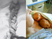 Bà bầu - Cặp sinh đôi mắc bệnh hiếm, hai dây rốn đan nhau như tết tóc vẫn sống sót kỳ diệu, chào đời cực xinh