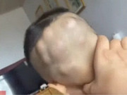 Yêu con - Mẹ tắm cho con 6 tuổi thì điếng người phát hiện đầu bé mọc đầy khối u to, đến bệnh viện bác sĩ nói: Thật hiếm gặp!