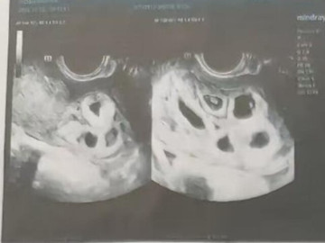 Bà bầu - Đến bệnh viện chữa hiếm muộn, cô gái 25 tuổi sốc nặng khi nghe bác sĩ kết luận: Đang mang thai 9 con