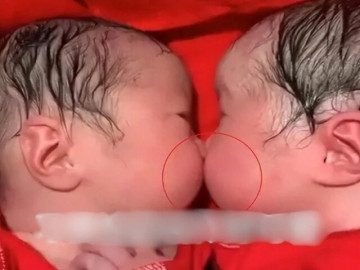 Yêu con - Vừa chào đời cặp chị em song sinh dính chặt nhau không rời, bác sĩ đỡ đẻ nhìn mẹ lắc đầu: “Ca này lạ quá”