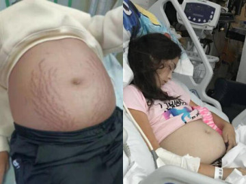 Yêu con - Bé gái lớp 9 bụng phình to như mang bầu, bác sĩ khám cho đứa trẻ nói 3 từ khiến mẹ kinh hãi ngã quỵ