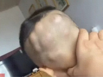 Yêu con - Mẹ tắm cho con 6 tuổi thì điếng người phát hiện đầu bé mọc đầy khối u to, đến bệnh viện bác sĩ nói: Thật hiếm gặp!