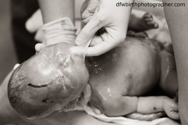 Đây là khoảnh khắc mà nữ hộ sinh đang bóc lớp màng khỏi người em bé, được chụp bởi nhiếp ảnh gia Lynsey Stone.

