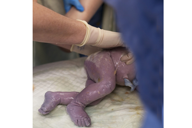 Không giống như những trẻ sơ sinh khác, vì em bé có ngôi thai ngược nên chân là bộ phận lọt lòng mẹ đầu tiên.
