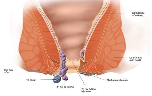 Cơ hội duy nhất thoát bệnh trĩ với mức phí 0đ - 1