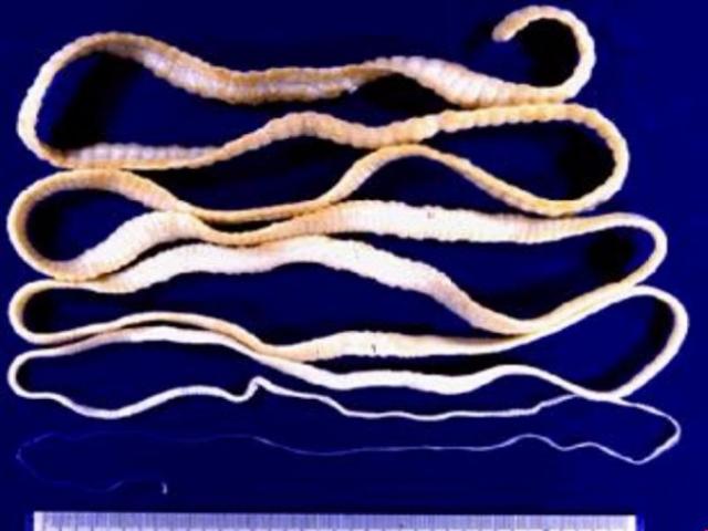 Kinh hãi con sán xơ mít dài 5 mét trong bụng bà cụ 82 tuổi