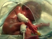 Tin tức - Vài giây trước khi bị đưa xuống huyệt mộ, bé gái sinh non 24 tuần bất ngờ sống lại