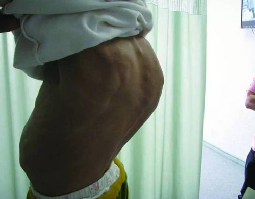 Mắc hội chứng hiếm gặp, cô bé 11 tuổi phải sống trong ngoại hình của cụ bà 80 - 3