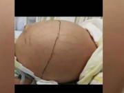 Làm mẹ - Bụng con phình to tưởng phát triển tốt, bố mẹ giật mình khi biết sự thật