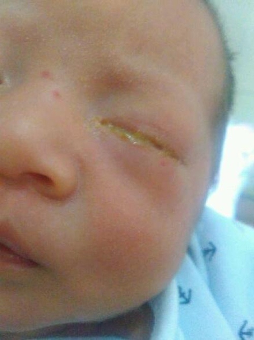 Người mẹ sốc nặng khi biết nguyên nhân mắt con nhỏ sưng húp, chảy mủ - 1