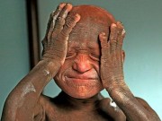 Làm mẹ - Ngỡ ngàng trước diện mạo mới "thay da đổi thịt" của cậu bé 11 tuổi mắc căn bệnh "hóa đá"
