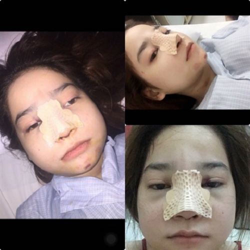 Chi bạo tiền thẩm mỹ, nhan sắc trước và sau của cô gái 9x khiến ai cũng phải choáng - 4