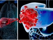 Sức khỏe - Nhận biết 6 dấu hiệu ung thư gan trước khi quá muộn
