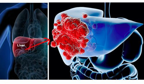 Identify 6 signs of liver cancer before it's too late