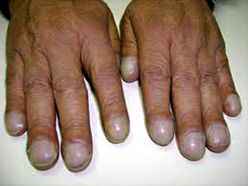 Nhìn màu sắc móng tay, móng chân, đoán bệnh amp;#39;chuẩn không cần chỉnhamp;#39; - 3