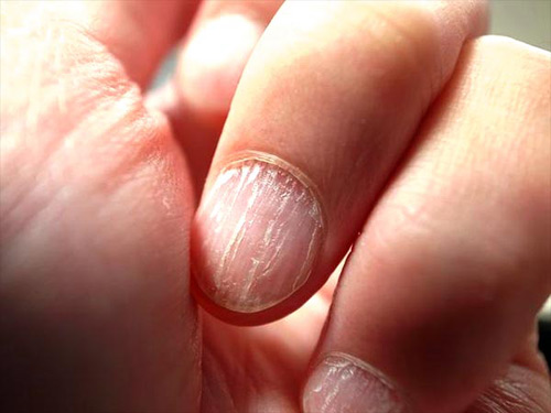 Nhìn màu sắc móng tay, móng chân, đoán bệnh amp;#39;chuẩn không cần chỉnhamp;#39; - 5