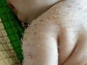 Làm mẹ - Bé sơ sinh nhập viện khẩn cấp vì người mọc chi chít gai, mẹ ngạc nhiên khi nghe bác sĩ nói