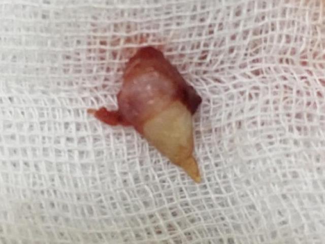 Kỳ lạ: Răng mọc trong mũi của bé gái 4 tuổi ở Hà Nội