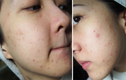 Cẩm nang da mụn: Nguyên nhân và cách triệt hạ tận gốc các nốt mụn đáng ghét - 1
