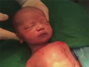 Clip Eva - Video: Đầu em bé tự bật ra khỏi bụng mẹ trong ca sinh mổ
