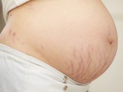 Bà bầu - Mẹ làm 4 việc “dễ ợt” này sẽ không bao giờ lo bị rạn da khi mang thai
