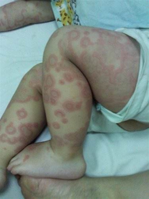 Thấy cháu há miệng nên bà cho ăn vài thìa trứng, ít phút sau phải nhập viện khẩn cấp - 3