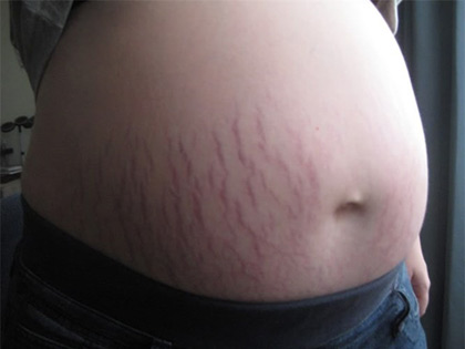 Chị em đừng xấu hổ vì những vết rạn xấu xí, hãy dùng bí quyết từ củ nghệ - 1