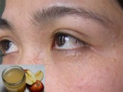 Làm đẹp - 2 cách trị mụn thịt nhanh và hiệu quả sẽ khiến bạn tiếc hùi hụi vì không biết sớm hơn