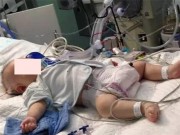 Làm mẹ - Uống sữa công thức đặc hơn tiêu chuẩn, bé sơ sinh 1 tháng phải... cắt ruột