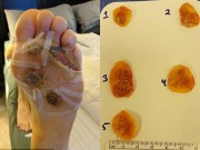 Tin tức - Nhiễm vi khuẩn ăn thịt vì thói quen đi chân trần ở phòng tập gym