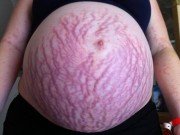 Bà bầu - Tưởng chỉ là rạn da, bà mẹ này đã phải mổ đẻ sớm vì căn bệnh không ai ngờ