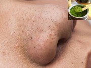 Làm đẹp - Tiêu diệt mụn đầu đen chỉ trong tích tắc với công thức đơn giản từ nhà bếp