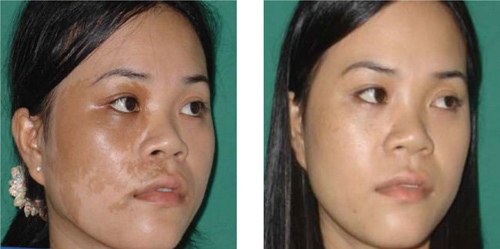 “Siêu phẩm” trị nám gây sốt giới làm đẹp đã có mặt tại Việt Nam - 3