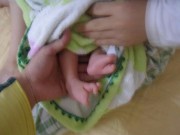 Làm mẹ - Xót thương bé sơ sinh chào đời với hình dạng bàn tay, bàn chân giống như càng cua