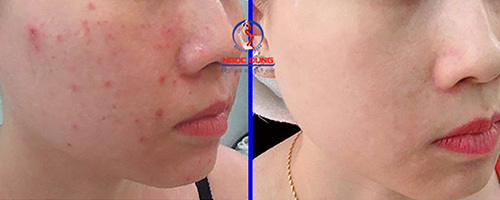 Không lo mụn, tự tin với làn da khỏe đẹp mùa hè - 1