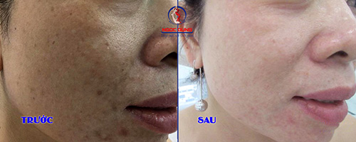 Không lo mụn, tự tin với làn da khỏe đẹp mùa hè - 2